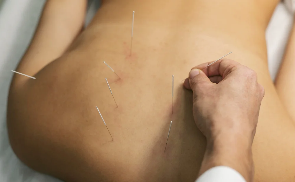 FIMS and Dry Needling